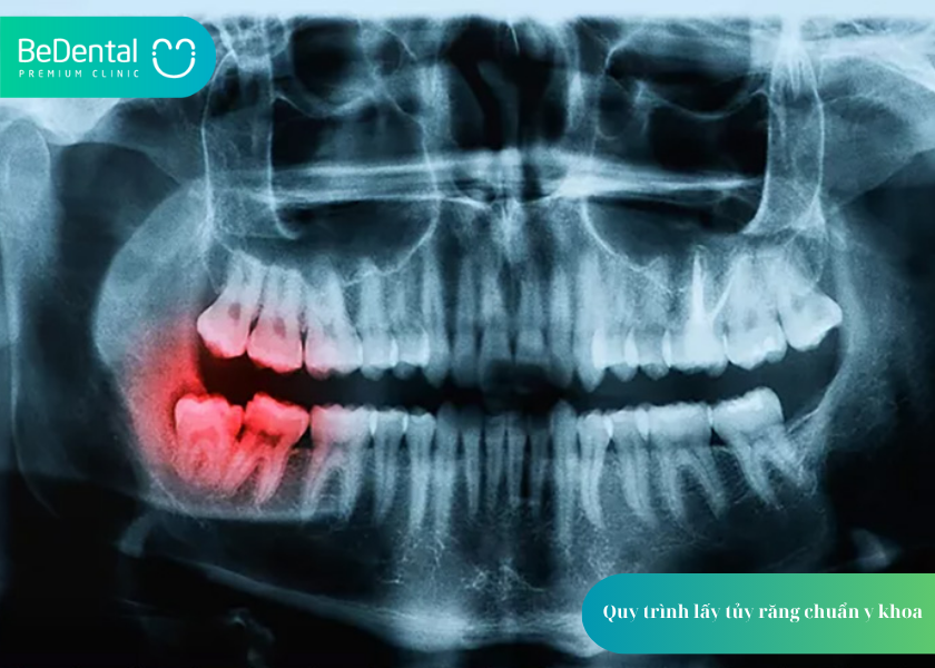 Quy trình lấy tủy răng: Giải pháp bảo tồn răng thật an toàn, hiệu quả 3 How much does teeth whitening cost 10 1