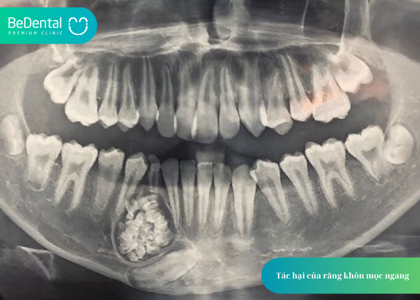 Răng Khôn Mọc Ngang: Nguy Hiểm Như Thế Nào Và Xử Lý Ra Sao? 3 How much does teeth whitening cost 10 2