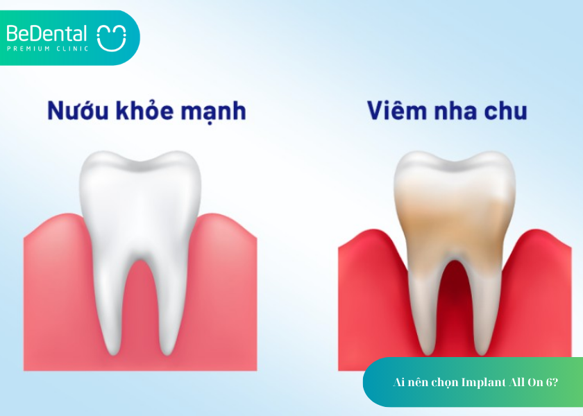 Trồng răng Implant All on 6: Giải pháp phục hình toàn hàm tối ưu cho người mất răng 4 How much does teeth whitening cost 10 4