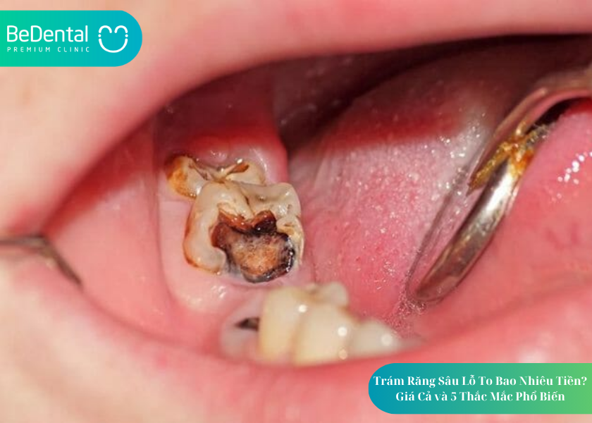 Trám răng sâu lỗ to bao nhiêu tiền? Trám răng sâu lỗ to bao nhiêu tiền?