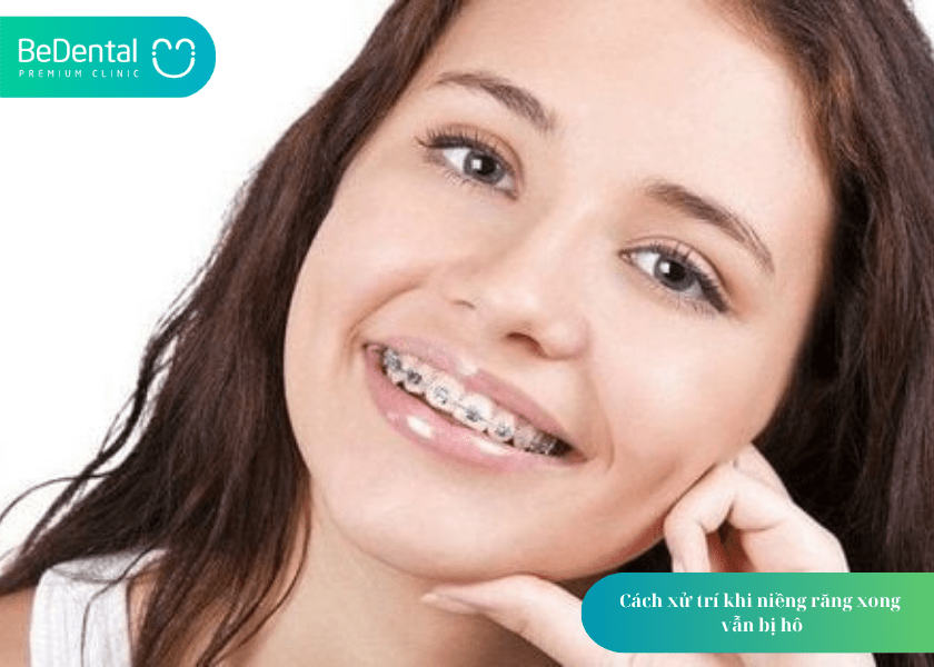 Niềng răng xong bị hô: Vì sao lại xảy ra và cách khắc phục? 3 How much does teeth whitening cost 10 min 1