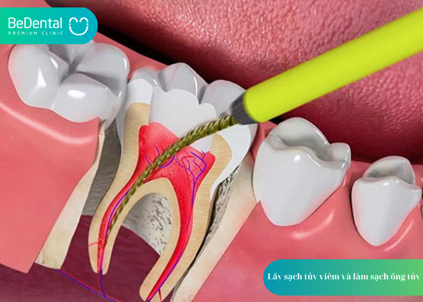 Quy trình lấy tủy răng: Giải pháp bảo tồn răng thật an toàn, hiệu quả 4 How much does teeth whitening cost 11 1