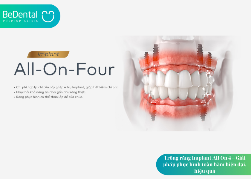 Trồng răng Implant All On 4