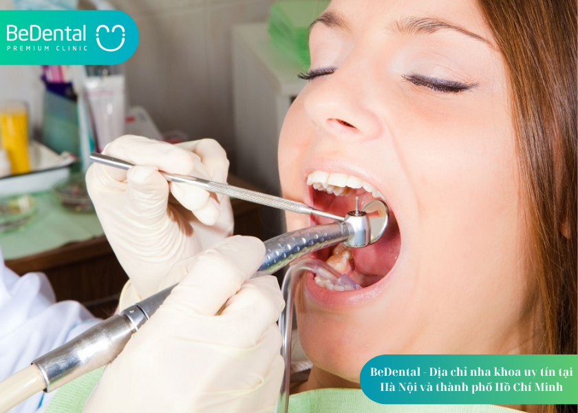 Trồng răng Implant All on 6: Giải pháp phục hình toàn hàm tối ưu cho người mất răng 5 How much does teeth whitening cost 11 4