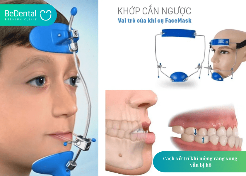 Niềng răng xong bị hô: Vì sao lại xảy ra và cách khắc phục? 4 How much does teeth whitening cost 11 min 1