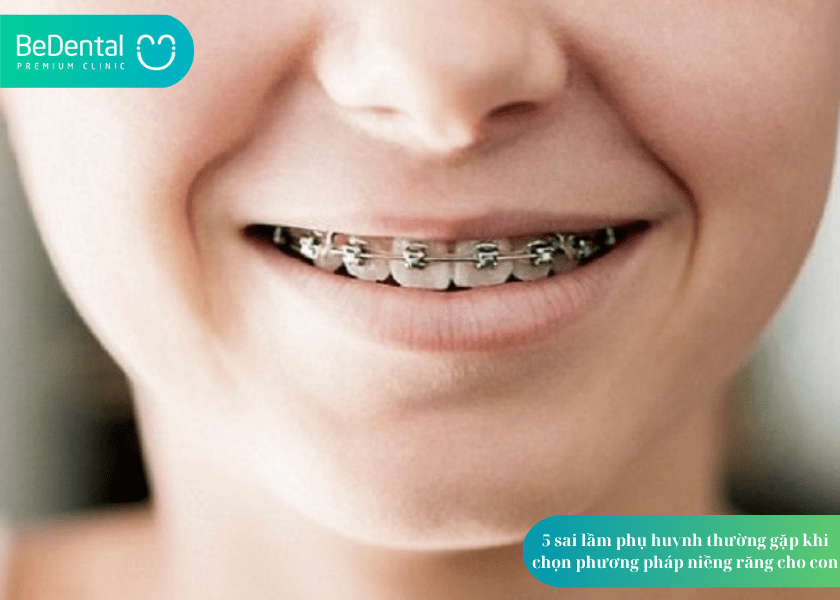Niềng răng trẻ em và 5 sai lầm phụ huynh thường gặp khi chọn phương pháp niềng răng cho con 4 How much does teeth whitening cost 11 min