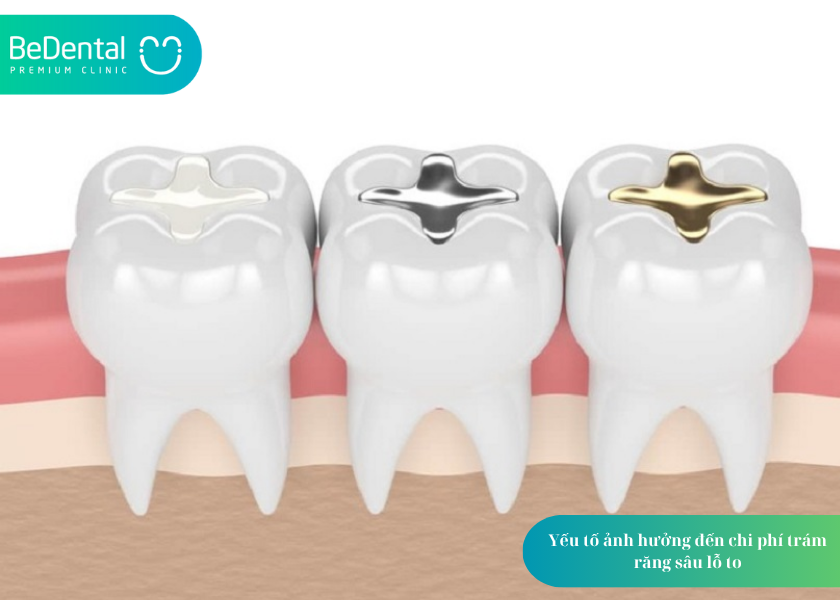 Trám Răng Sâu Lỗ To Bao Nhiêu Tiền? Giá Cả và 5 Thắc Mắc Phổ Biến 3 How much does teeth whitening cost 12 5