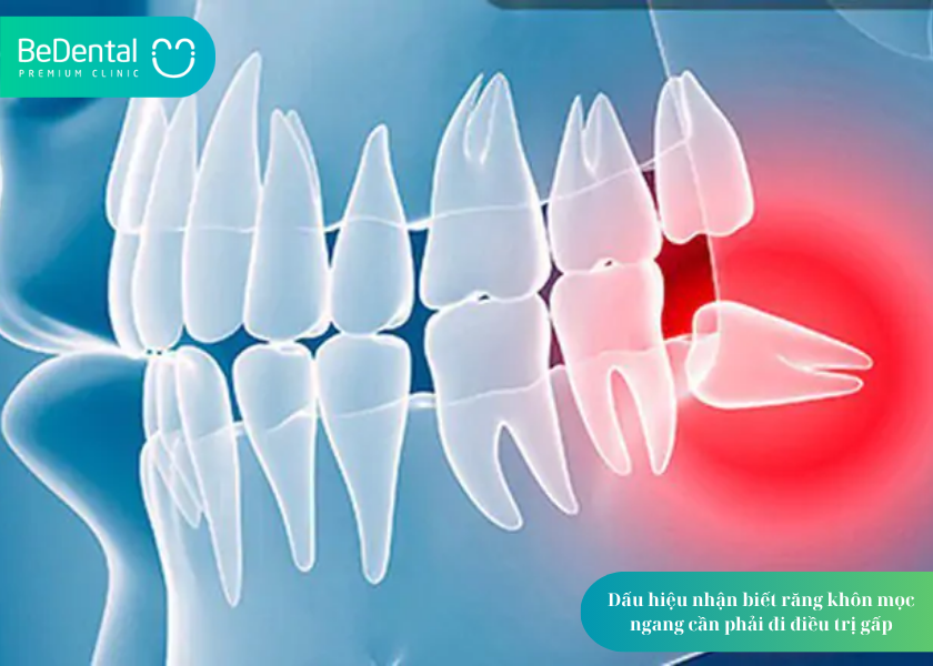 Răng Khôn Mọc Ngang: Nguy Hiểm Như Thế Nào Và Xử Lý Ra Sao? 5 How much does teeth whitening cost 13 2