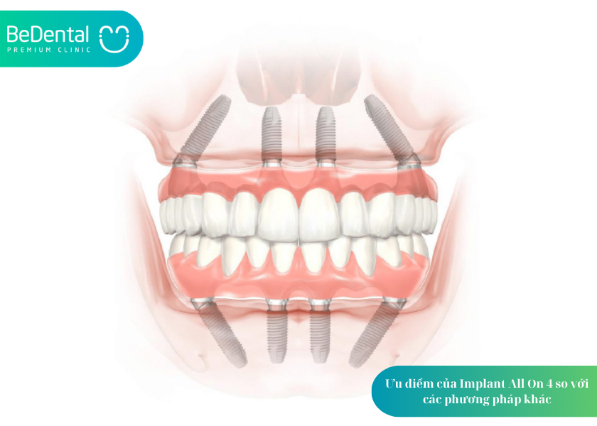 How much does teeth whitening cost 13 3
