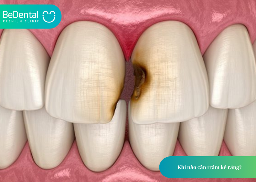 How much does teeth whitening cost 13 4
