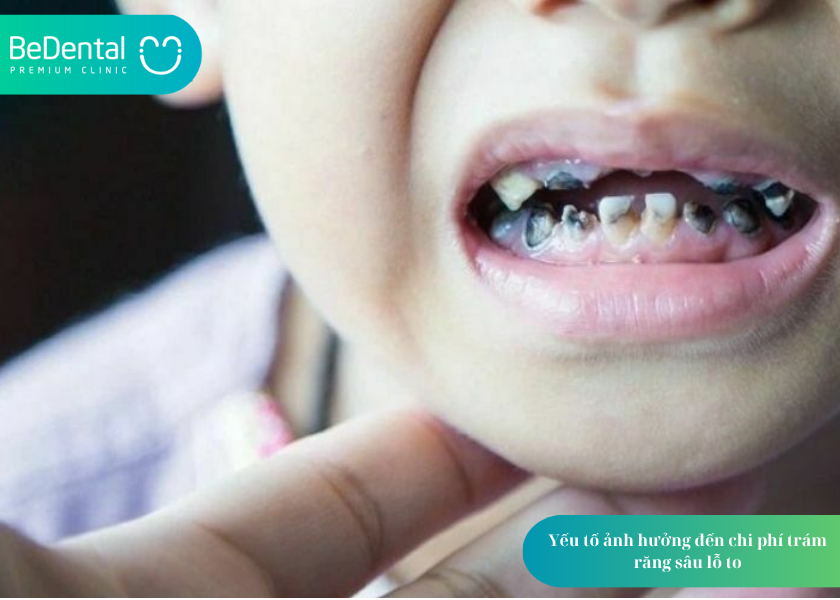 Trám Răng Sâu Lỗ To Bao Nhiêu Tiền? Giá Cả và 5 Thắc Mắc Phổ Biến 4 How much does teeth whitening cost 13 5