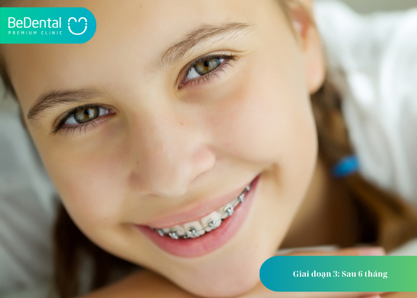 Quá Trình Niềng Răng: Từ Khám Đầu Tiên Đến Kết Quả Hoàn Thiện 3 How much does teeth whitening cost 14 1