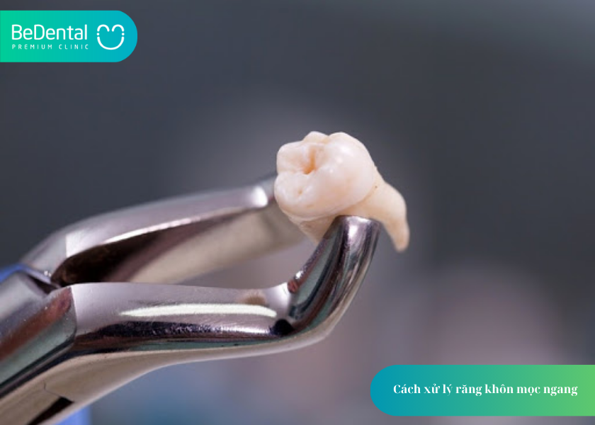 Răng Khôn Mọc Ngang: Nguy Hiểm Như Thế Nào Và Xử Lý Ra Sao? 6 How much does teeth whitening cost 14 2