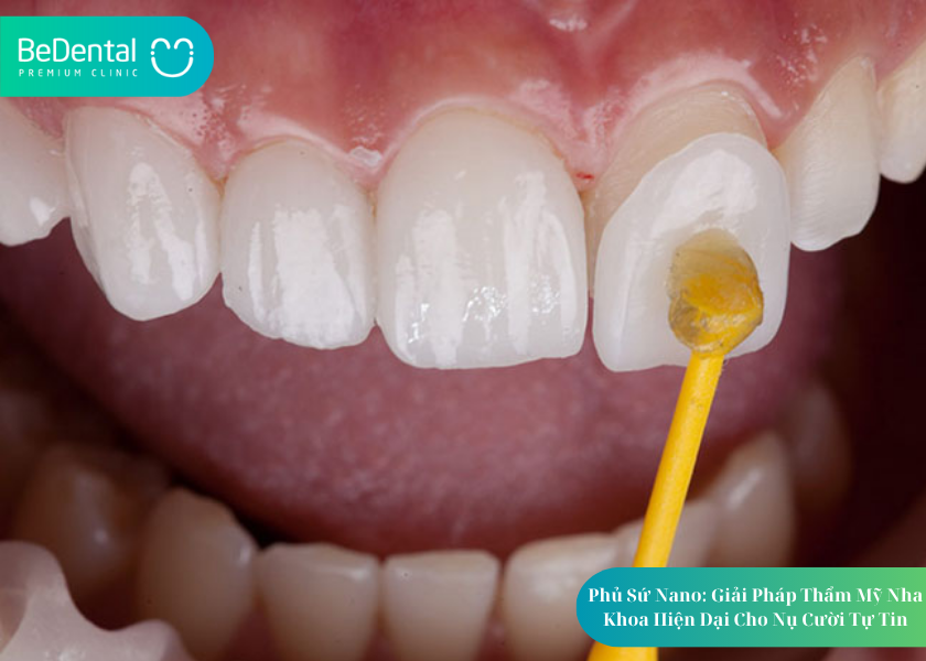 How much does teeth whitening cost 14