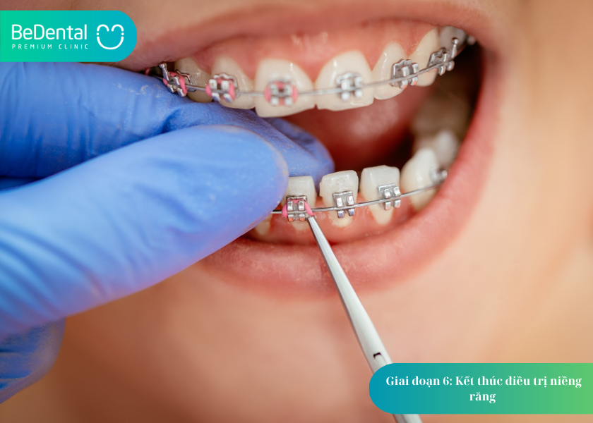 Quá Trình Niềng Răng: Từ Khám Đầu Tiên Đến Kết Quả Hoàn Thiện 4 How much does teeth whitening cost 15 1