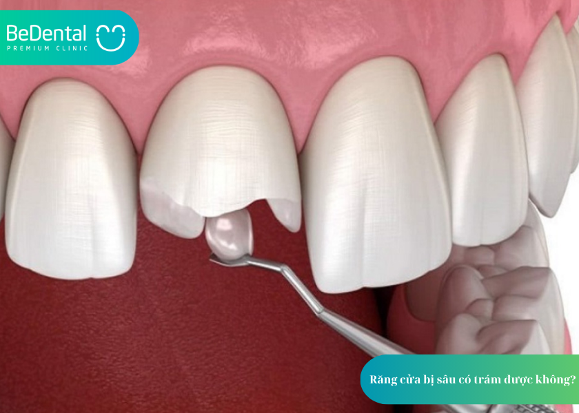 Trám Răng Sâu Lỗ To Bao Nhiêu Tiền? Giá Cả và 5 Thắc Mắc Phổ Biến 6 How much does teeth whitening cost 15 5