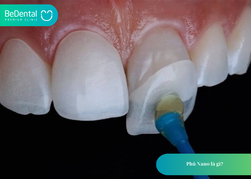 How much does teeth whitening cost 15