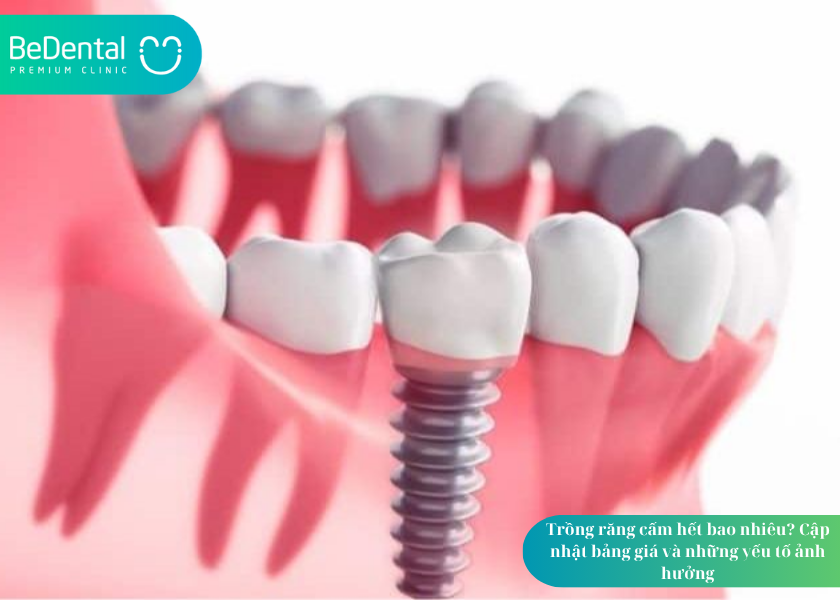 Trồng răng cấm hết bao nhiêu?