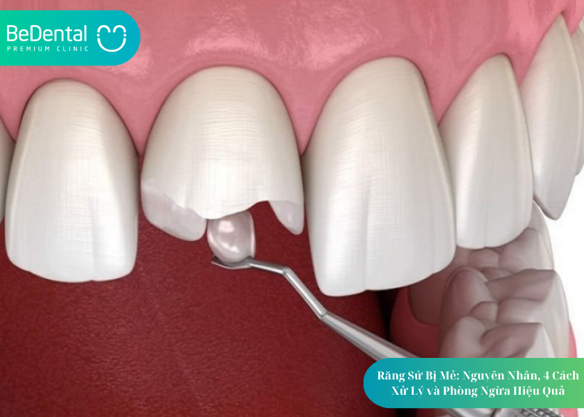 Nguyên nhân khiến răng sứ bị mẻ