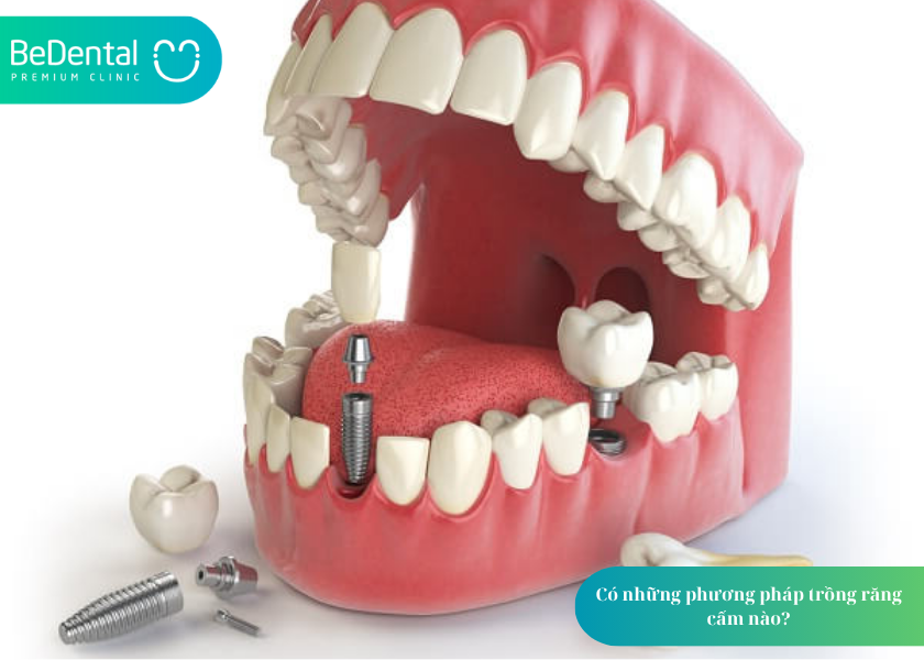 How much does teeth whitening cost 17 4