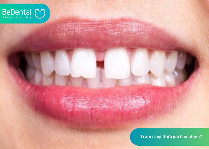 Trám răng thưa giá bao nhiêu? Bảng giá và 3 điều cần biết trước khi thực hiện 2 How much does teeth whitening cost 17 6