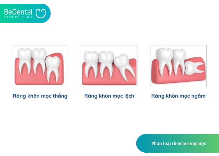 Cấu Tạo Của Răng Khôn: 4 Điều Bạn Cần Biết 4 How much does teeth whitening cost 18 2