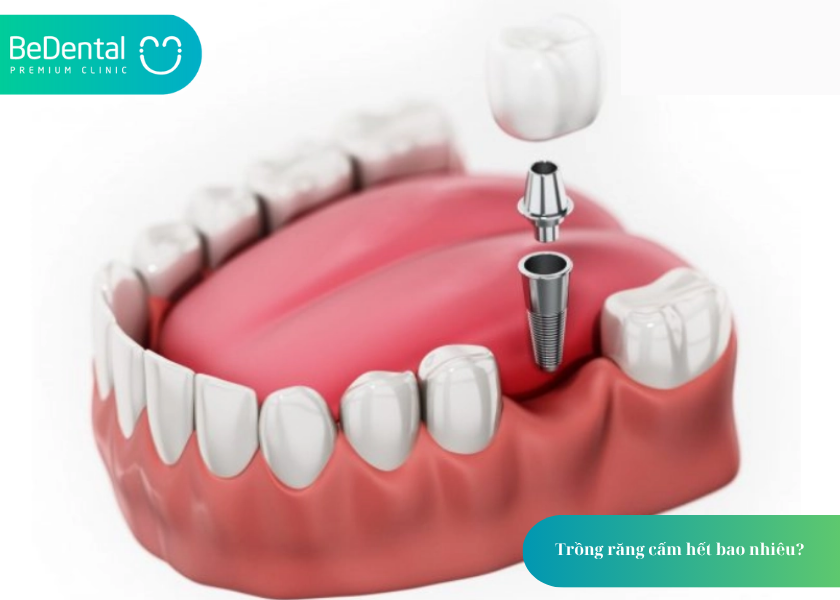 How much does teeth whitening cost 18 4