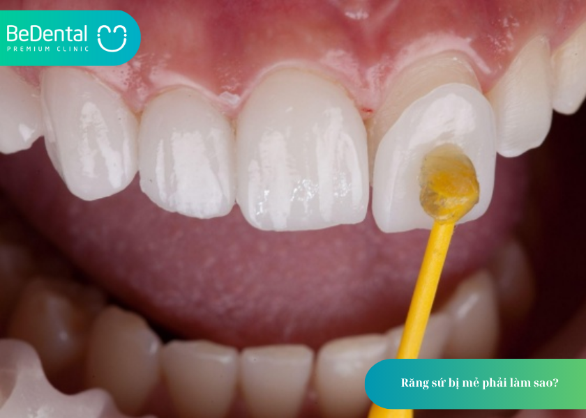 Răng Sứ Bị Mẻ: Nguyên Nhân, 4 Cách Xử Lý và Phòng Ngừa Hiệu Quả 3 How much does teeth whitening cost 18 5