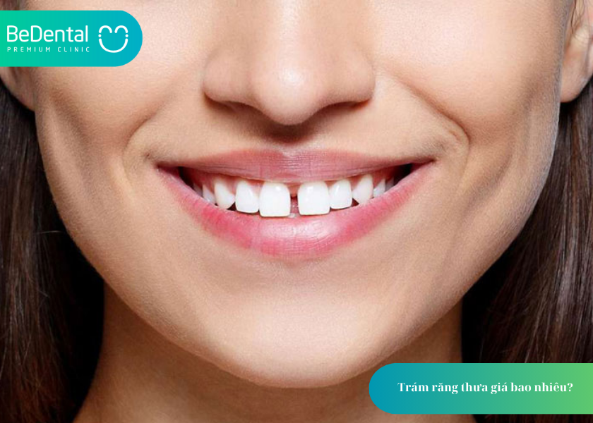 Trám răng thưa giá bao nhiêu? Bảng giá và 3 điều cần biết trước khi thực hiện 3 How much does teeth whitening cost 18 6