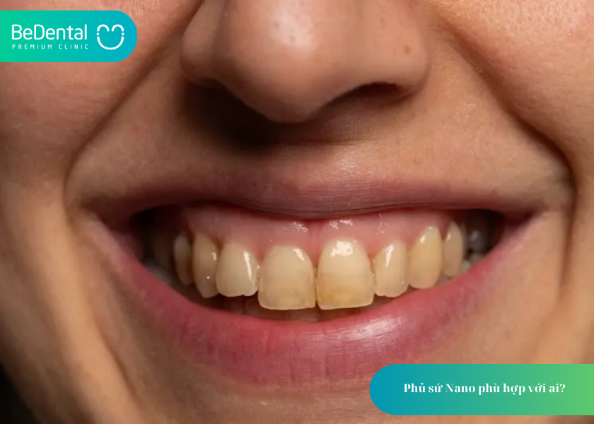 Phủ Sứ Nano: Giải Pháp Thẩm Mỹ Nha Khoa Hiện Đại Cho Nụ Cười Tự Tin 5 How much does teeth whitening cost 18