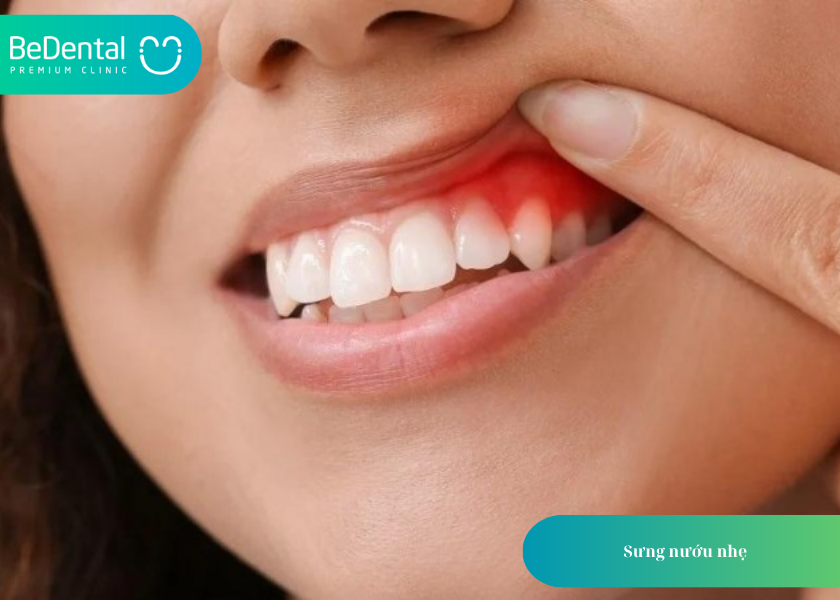 How much does teeth whitening cost 19 3