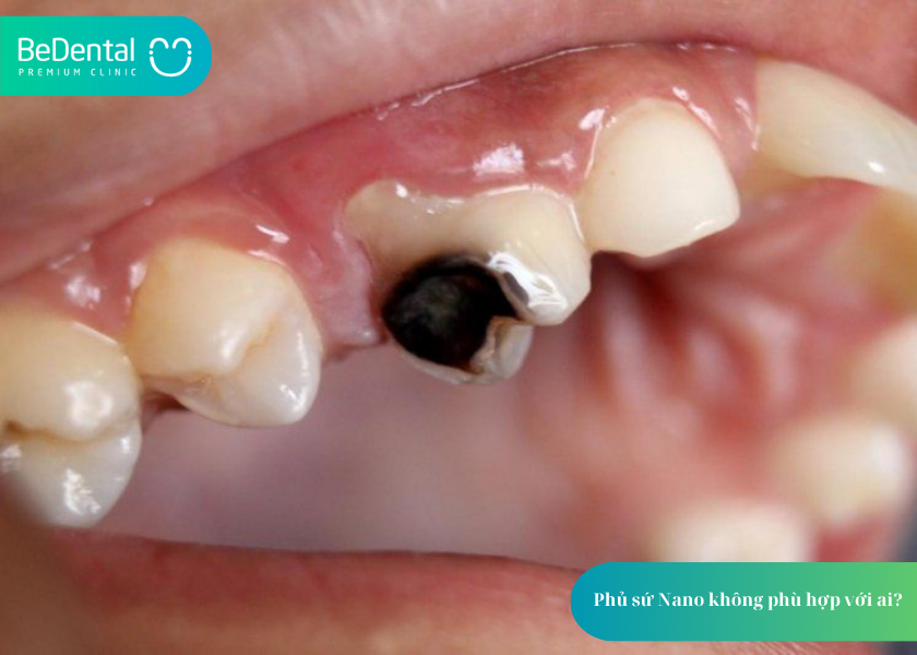 Phủ Sứ Nano: Giải Pháp Thẩm Mỹ Nha Khoa Hiện Đại Cho Nụ Cười Tự Tin 6 Công nghệ phủ răng sứ Nano giá bao nhiêu?