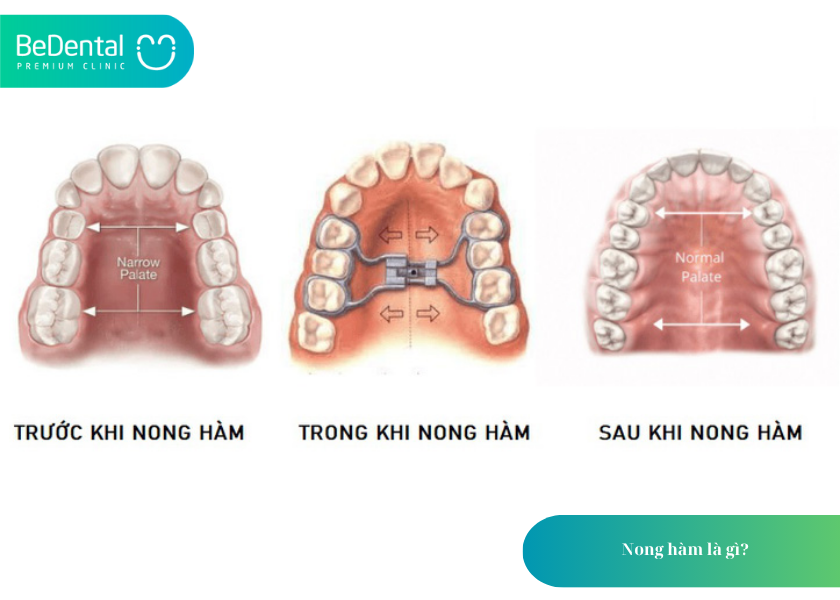 Nong Hàm: Giải Pháp Mở Rộng Cung Hàm An Toàn, Hiệu Quả – Khách Hàng Cần Lưu Ý Gì? 2 Nong hàm là gì?
