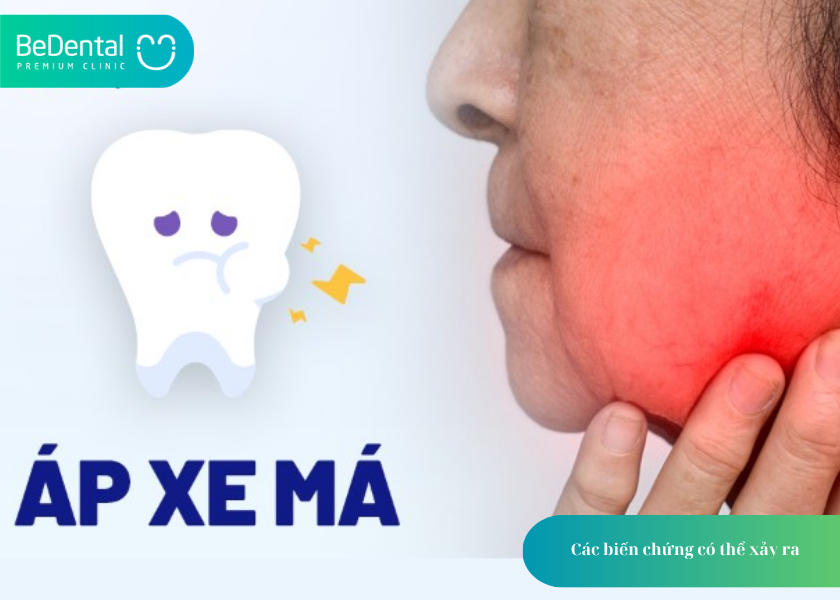 Răng Khôn Mọc Lệch Ra Má Hàm Trên: Tác Hại Và Cách Xử Lý 3 How much does teeth whitening cost 2 5