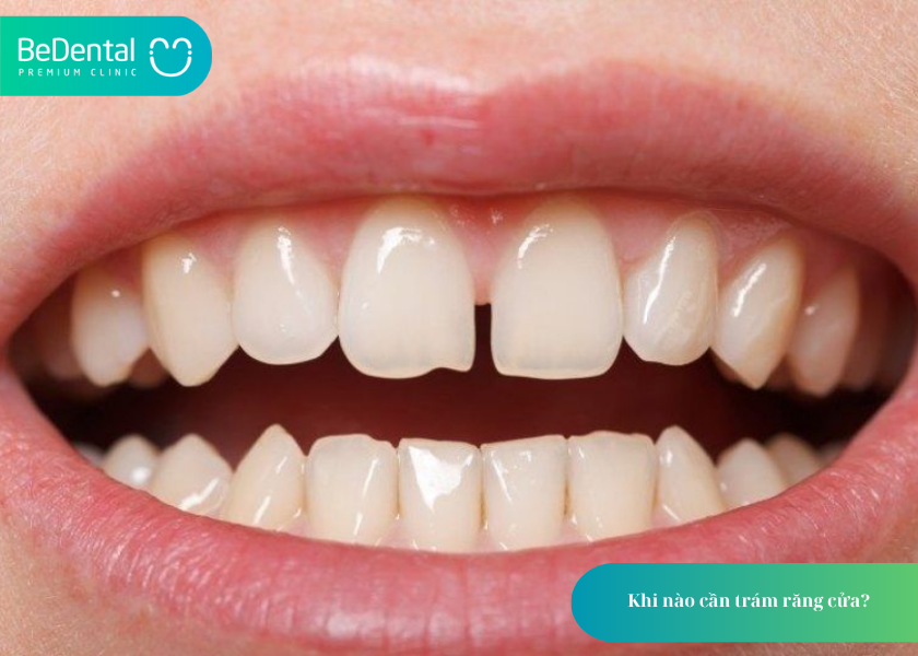 Trám Răng Cửa: Giải Pháp Thẩm Mỹ và Bảo Vệ Răng Hiệu Quả 2 Khi nào cần trám răng cửa?