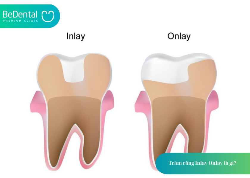 Trám Răng Inlay Onlay: Giải Pháp Phục Hình Hiện Đại, Bền Đẹp Cho Răng Sâu Nặng 2 How much does teeth whitening cost 2 8