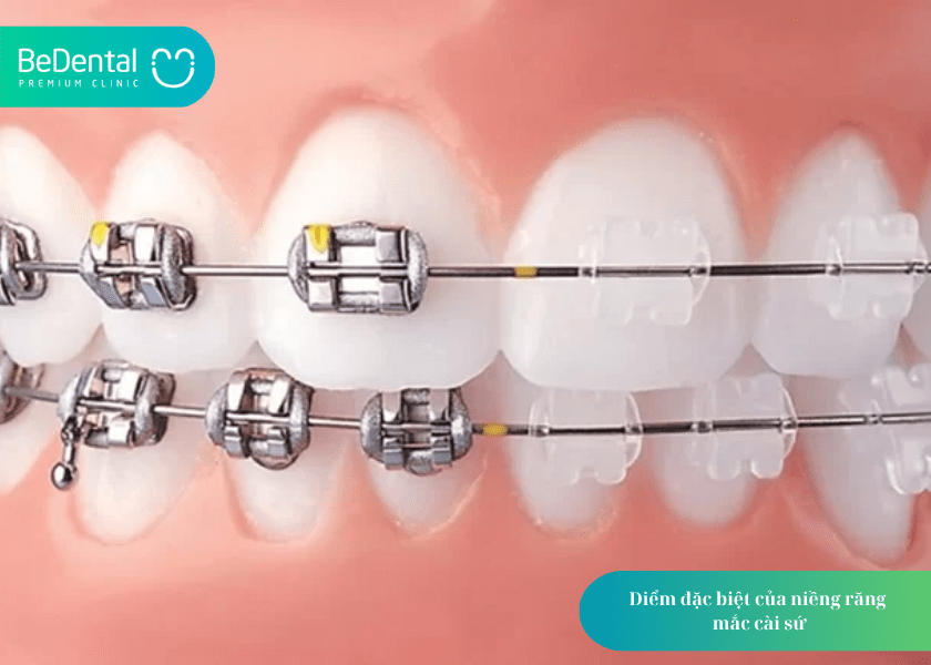 Niềng răng mắc cài sứ: Giải pháp chỉnh nha thẩm mỹ, hiệu quả cho nụ cười tự tin 2 How much does teeth whitening cost 2 min 1