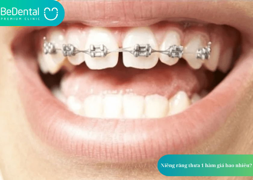 Niềng răng thưa 1 hàm giá bao nhiêu? Bảng giá chi tiết và lưu ý quan trọng 2 How much does teeth whitening cost 2 min 11