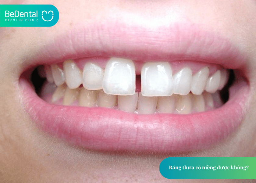 Niềng răng thưa mất bao lâu? Thời gian và 4 điều cần biết 2 How much does teeth whitening cost 2 min 12