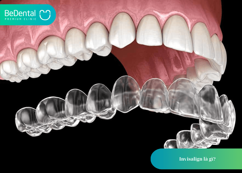 Niềng Invisalign là gì?