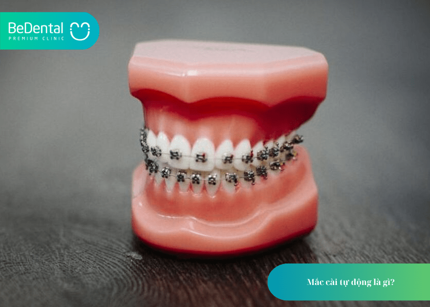 Mắc cài tự động: Giải pháp chỉnh nha tiên tiến giúp rút ngắn thời gian điều trị 2 Mắc cài tự động
