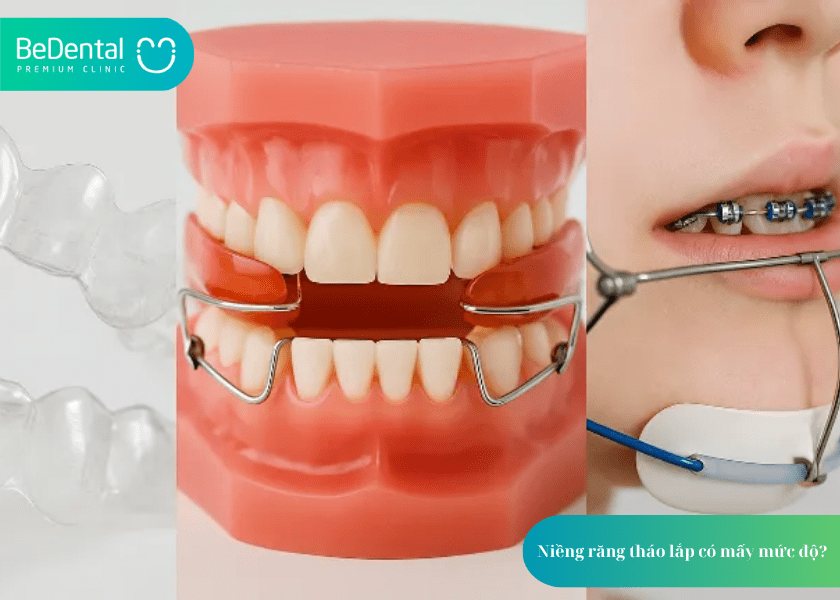 Niềng Răng Tháo Lắp Mức 1: Phương Pháp Chỉnh Nha Sớm Hiệu Quả Cho Trẻ Em 2 How much does teeth whitening cost 2 min 9
