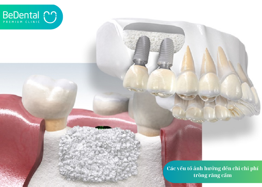 Trồng răng cấm hết bao nhiêu? Trồng răng cấm hết bao nhiêu? Trồng răng cấm hết bao nhiêu?