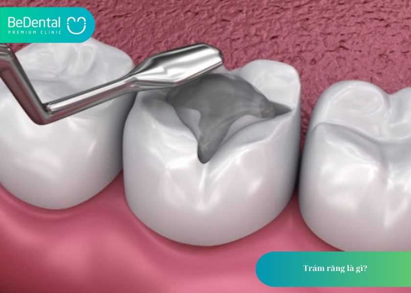 Trám Răng: Giải Pháp Hiệu Quả Bảo Tồn Răng Thật Và Khôi Phục Thẩm Mỹ 2 Trám răng là gì?