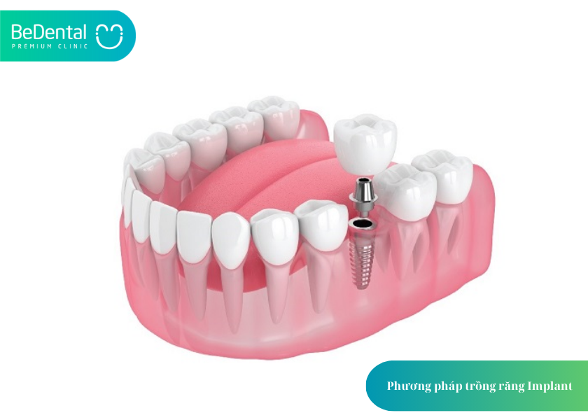 How much does teeth whitening cost 22 1
