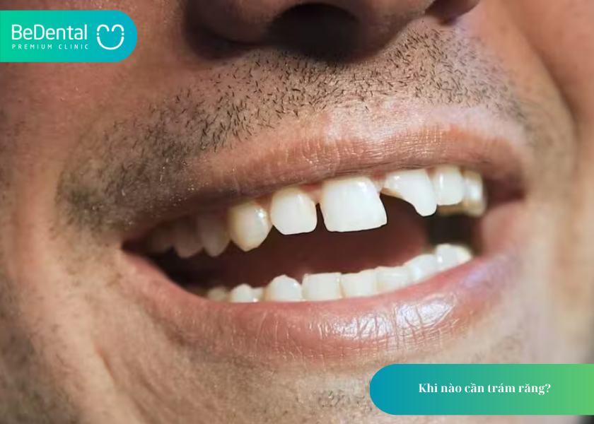 Trám Răng: Giải Pháp Hiệu Quả Bảo Tồn Răng Thật Và Khôi Phục Thẩm Mỹ 4 How much does teeth whitening cost 23 2