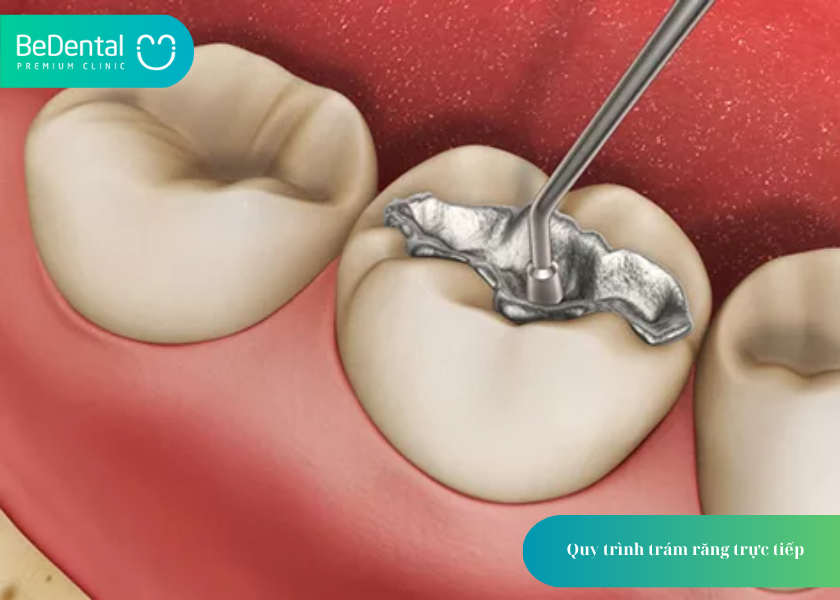 Trám Răng: Giải Pháp Hiệu Quả Bảo Tồn Răng Thật Và Khôi Phục Thẩm Mỹ 5 How much does teeth whitening cost 24 2