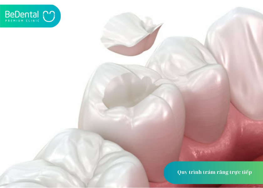 Trám Răng: Giải Pháp Hiệu Quả Bảo Tồn Răng Thật Và Khôi Phục Thẩm Mỹ 6 How much does teeth whitening cost 25 2