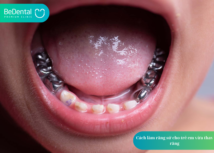 Quy Trình Làm Răng Sứ: Giải Pháp Hoàn Hảo Cho Nụ Cười Tự Tin 2 Quy trình làm răng sứ đặc biệt