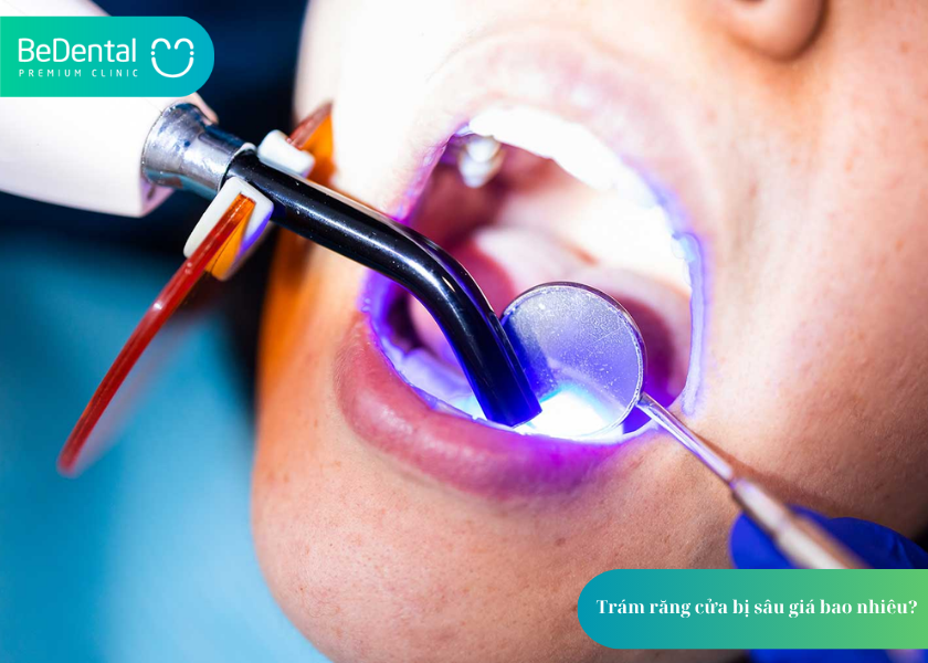 Trám răng cửa bị sâu giá bao nhiêu?